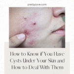 How to Know if You Have Cysts Under Your Skin and How to Deal With Them